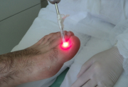 Micose Laser